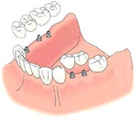 Posterior Replacement