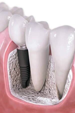 Single Tooth Implant