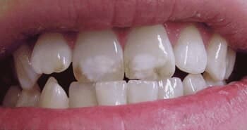 Fluorosis