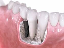 Dental Implant Diagram