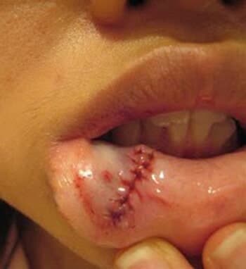 Lacerations and Cuts