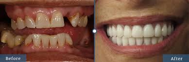 Reconstructed Fillings