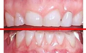 Teeth Grinding Bruxism