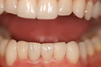 Veneers After 2