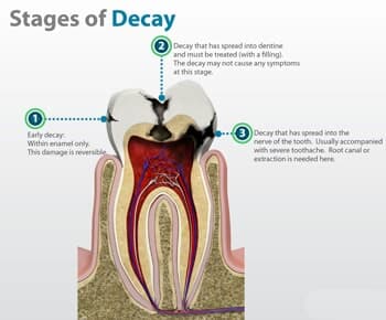 Tooth Decay and Cavities