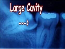 Impacted Wisdom Teeth
