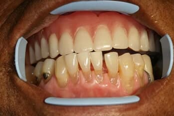 IMPLANTS - Full Lower Arch Restoration Before