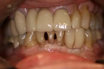 FULL MOUTH RECONSTRUCTION Before