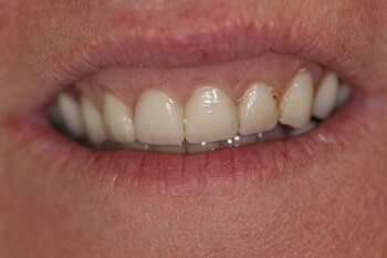 VENEERS - Full Smile Transformation Before