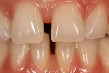 VENEERS - Gap Closure Before