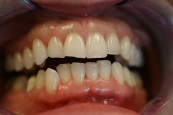 VENEERS - Whitening & Alignment Before