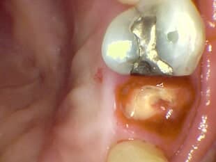IMPLANT - Single Tooth Restoration Before