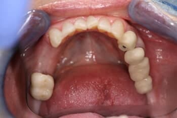 IMPLANTS - Full Arch Restoration Before