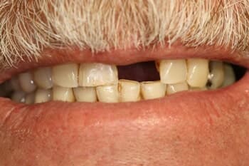 CROWNS - Complete Smile Makeover Before