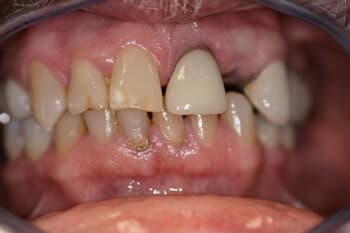 VENEERS - Severe Wear Restoration Before
