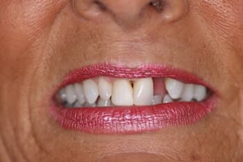VENEERS - Discoloration & Gap Correction Before