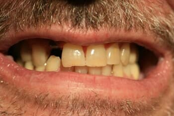 VENEERS - Comprehensive Cosmetic Enhancement Before